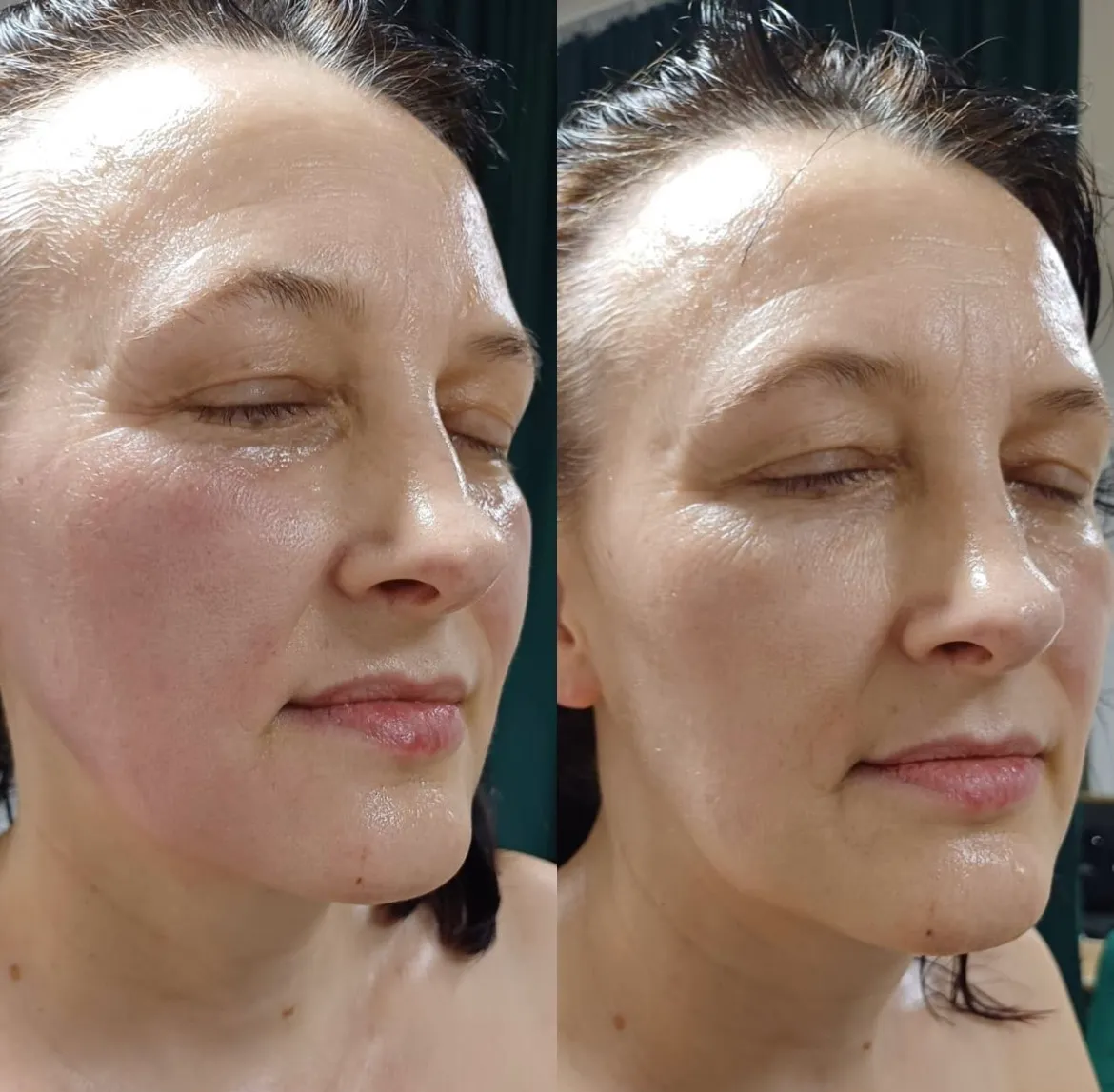 Efekty masażu bańką